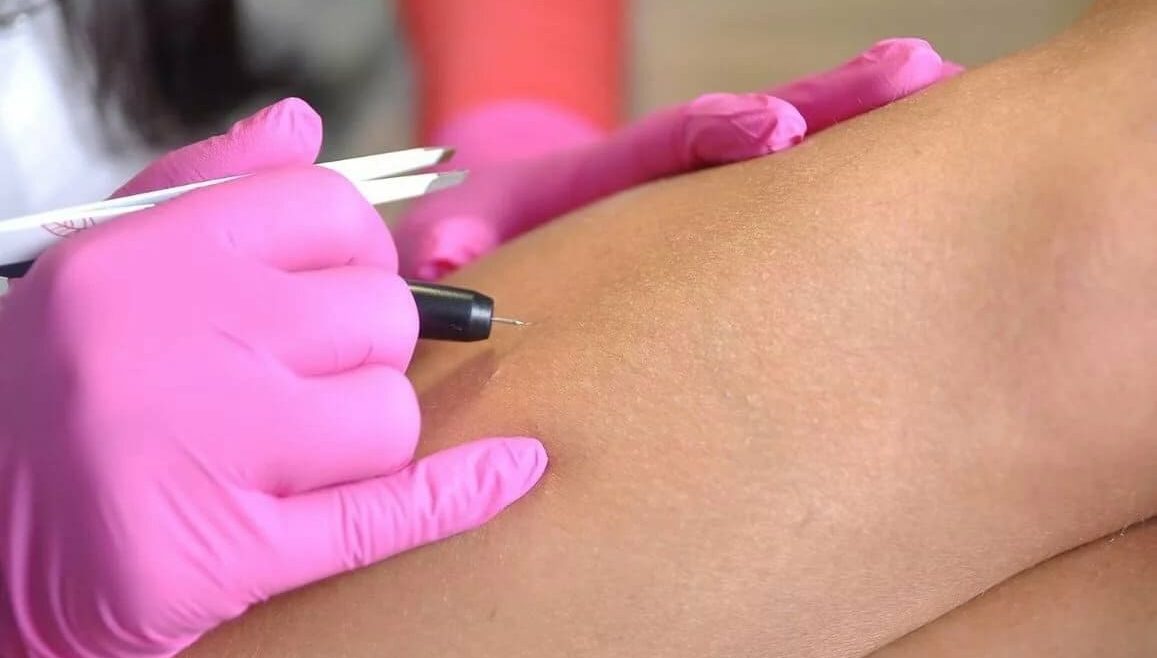Things to Be Considered in Needle Hair Removal
