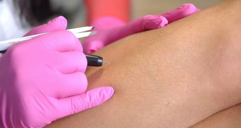 Things to Be Considered in Needle Hair Removal