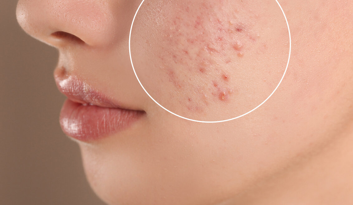Acne Care: Basic Tips and Effective Treatments
