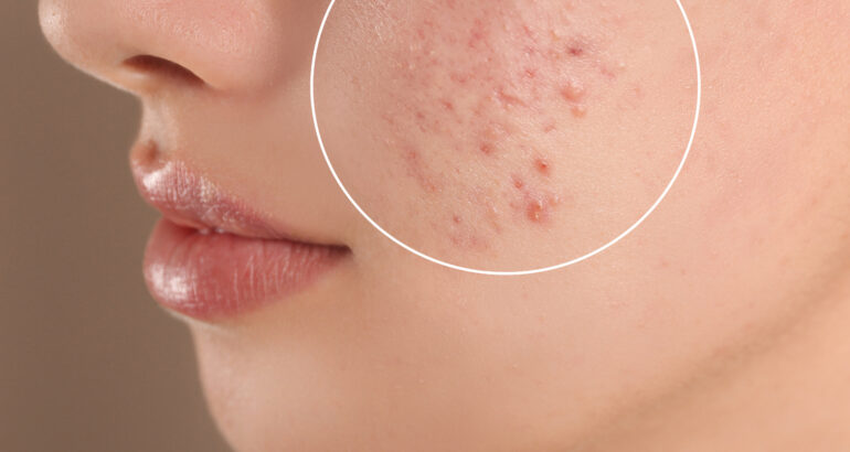 Acne Care: Basic Tips and Effective Treatments